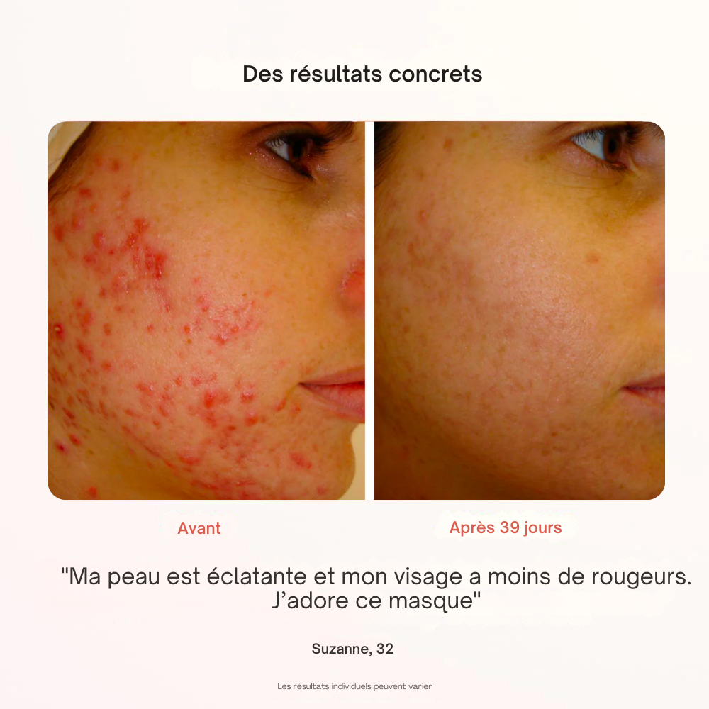 Masque Professionnel de Photothérapie - Misc image 16