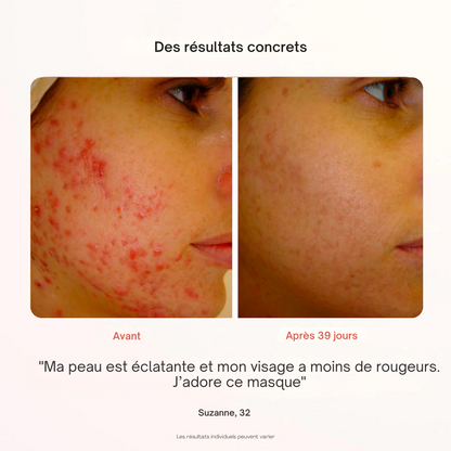 Masque Professionnel de Photothérapie - Misc image 16