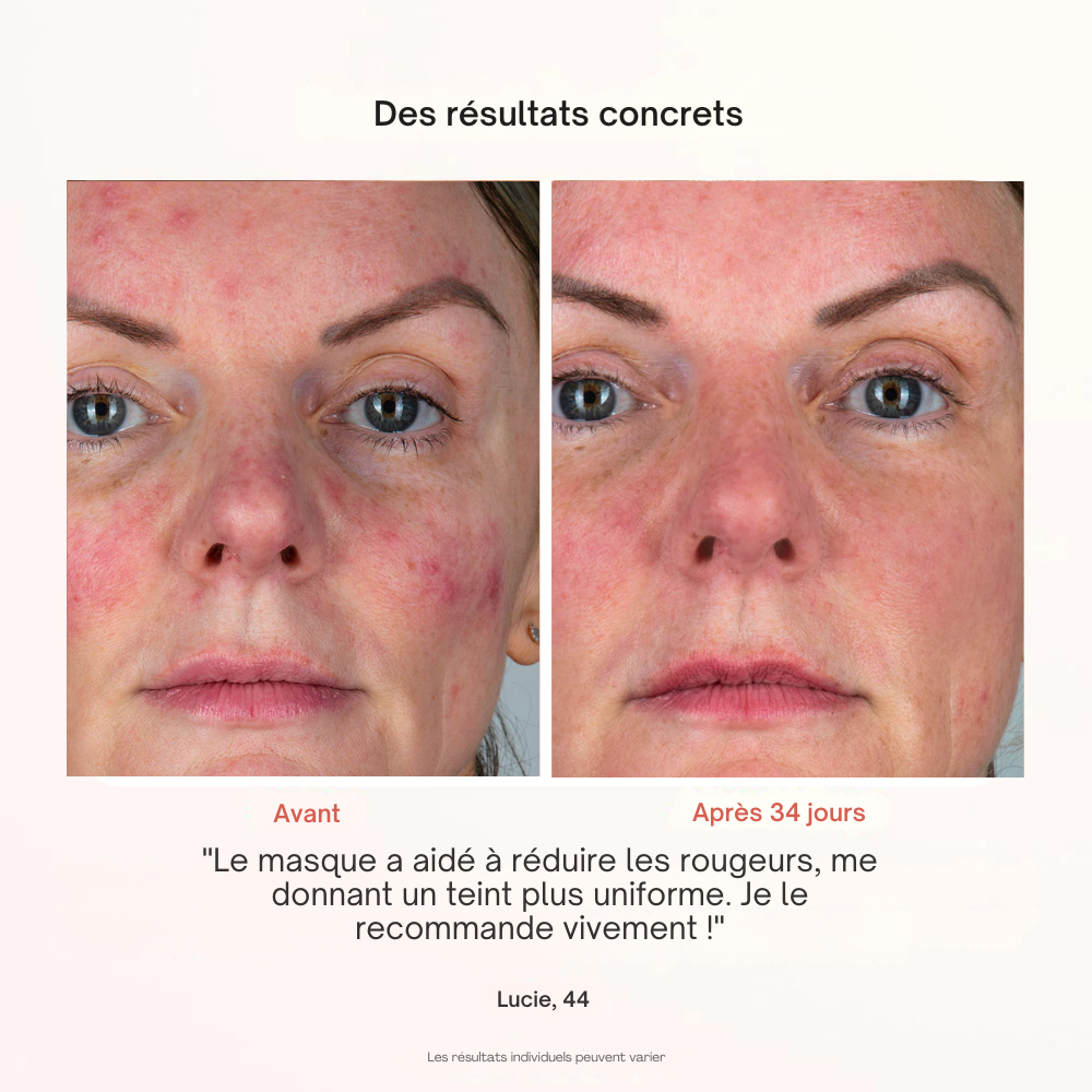 Masque Professionnel de Photothérapie - Misc image 12